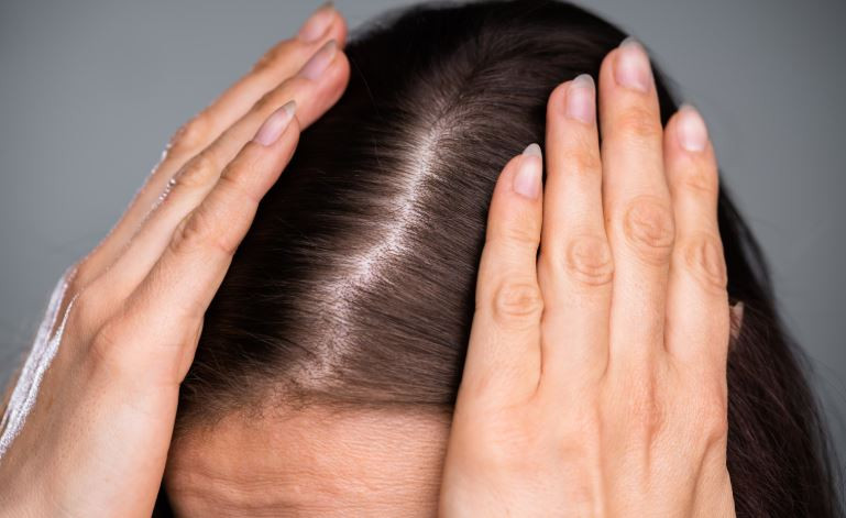  Hair Loss 